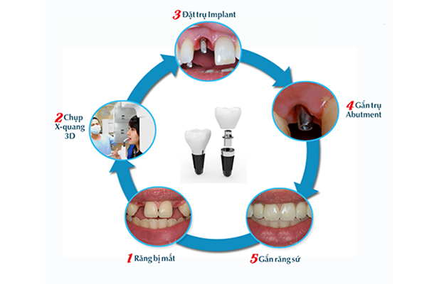 Quy trình cấy ghép răng implant