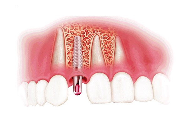 Trồng răng implant đang là phương pháp phục hình răng được ưa chuộng