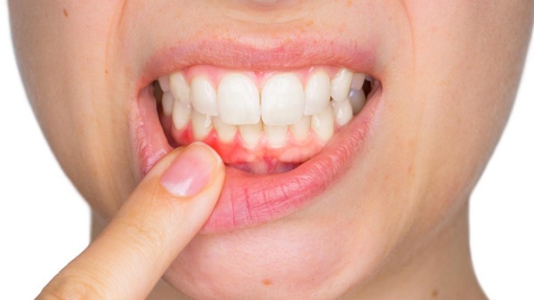 Hãy xây dựng thói quen chăm sóc răng miệng mỗi ngày, tránh các bệnh nha chu