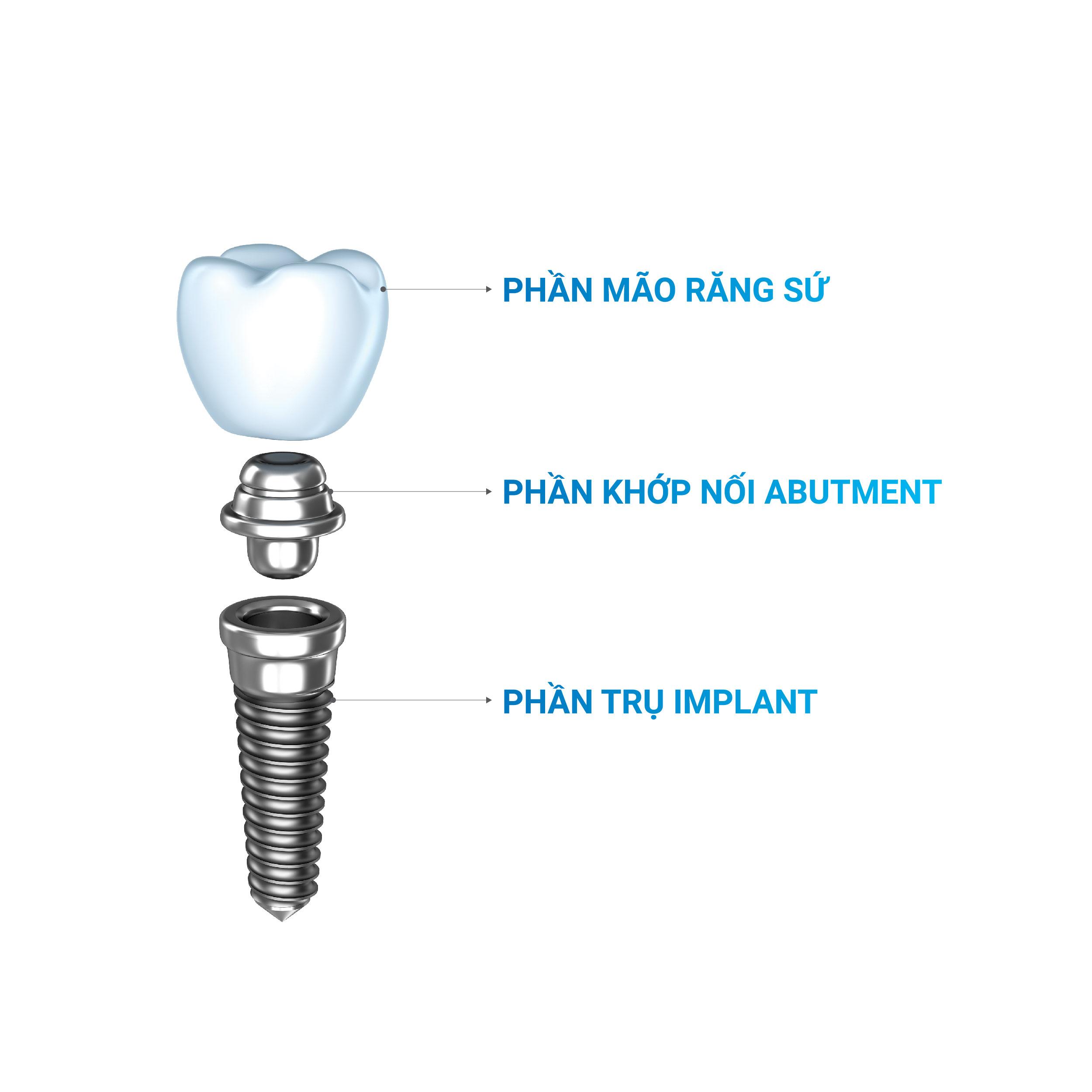 Giá thành của implant Hàn Quốc tương đối phải chăng