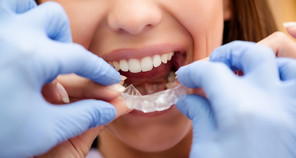 Không phải ai cũng có thể niềng răng không nhổ invisalign