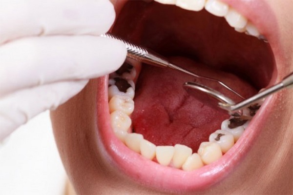 Sâu răng là bệnh răng miệng không chừa bất kỳ ai