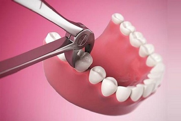 Cần cân nhắc kỹ trước khi nhổ răng số 6