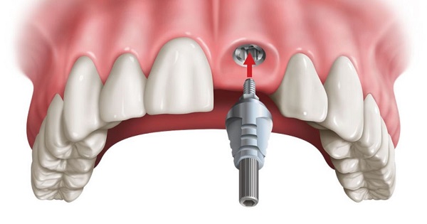 Trồng răng implant có thể gây đau và thốn nhẹ