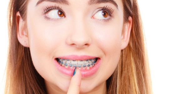 Vệ sinh răng miệng cẩn thận, tỉ mỉ sau khi niềng răng là công việc cực kỳ quan trọng