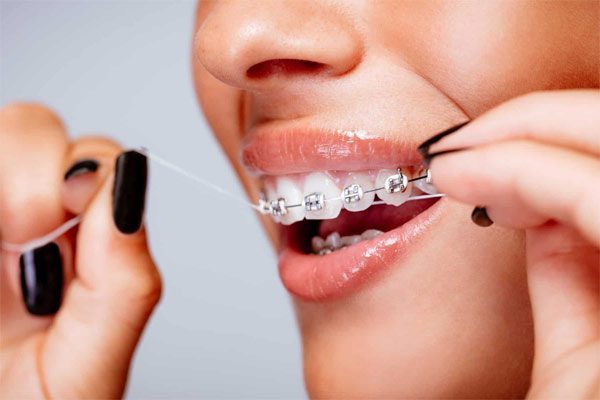 Sử dụng chỉ nha khoa là cách làm trắng răng khi niềng răng tại nhà