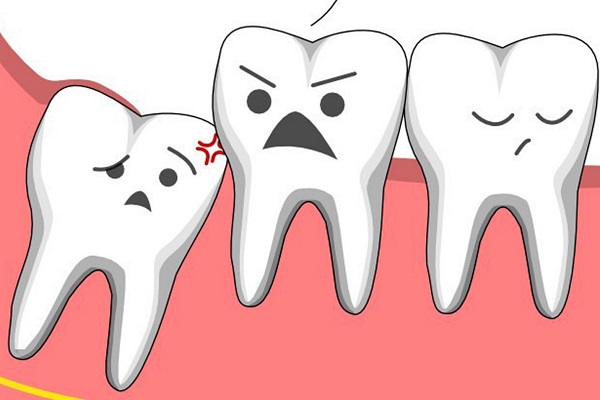 Răng khôn hay còn gọi là răng số 8 mọc ở cuối mỗi bên hàm