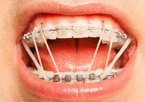 Niềng răng là việc tác dụng lực bằng các khí cụ như mắc cài, dây cung.
