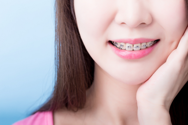 Tình trạng tuột mắc cài khi niềng răng không còn quá xa lạ