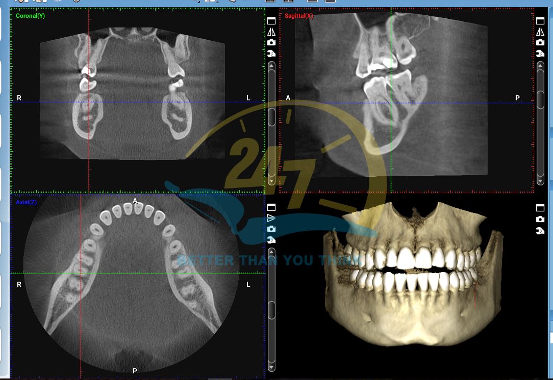 CBCT-hinh-anh-3D-chat-luong-1