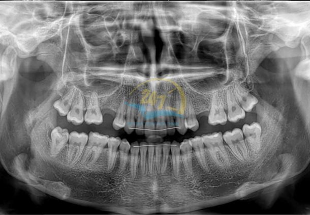 Chụp X-quang 3D-thumb