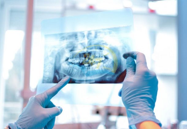 X-quang quanh chóp phù hợp với nhiều trường hợp khác nhau, giúp nha sĩ có thể đánh giá tổng quát nhất về tình trạng răng miệng của người bệnh