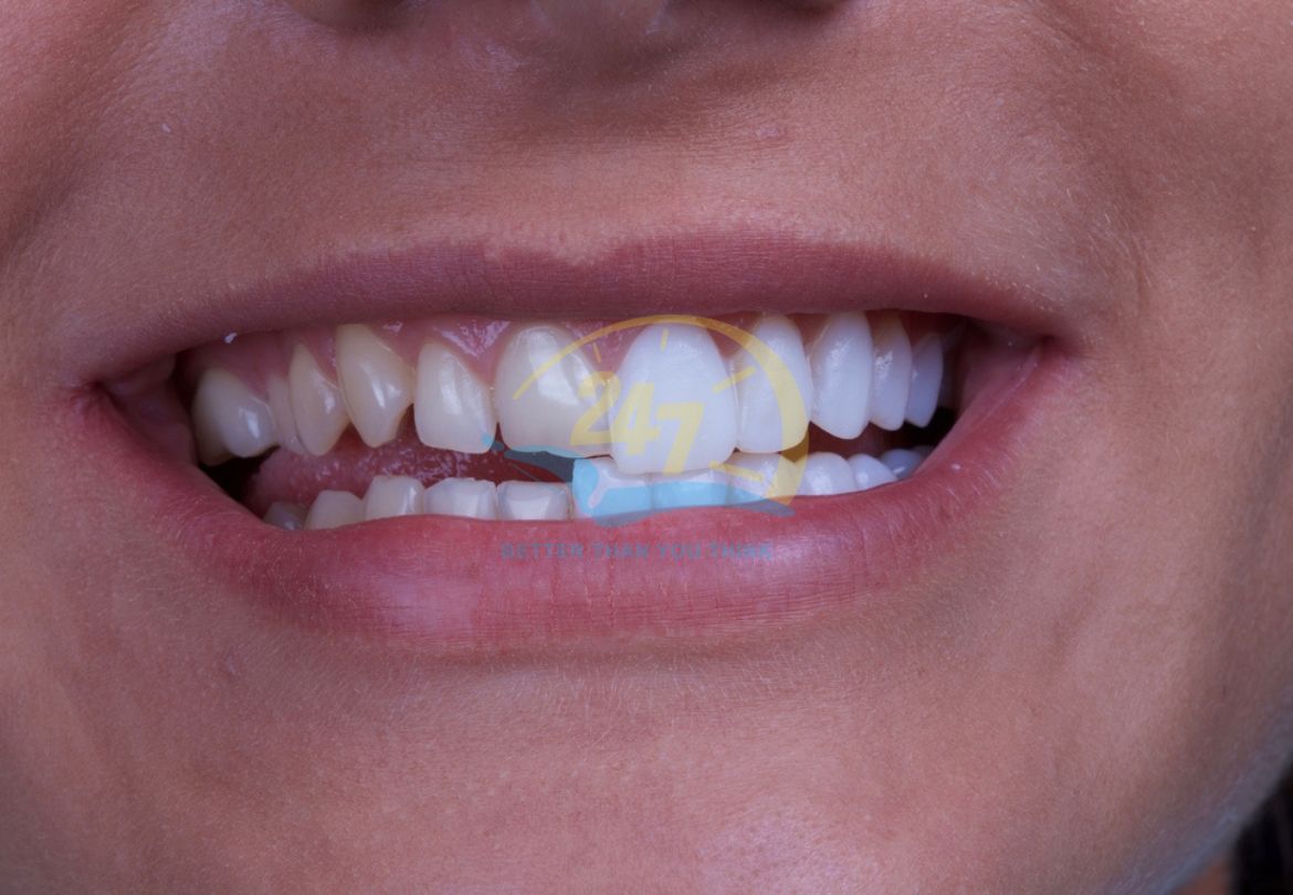 Răng sứ Lumineers rất mỏng nhẹ