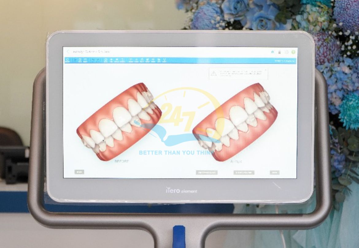Công nghệ lấy dấu mẫu hàm hiện đại khi làm răng sứ thẩm mỹ
