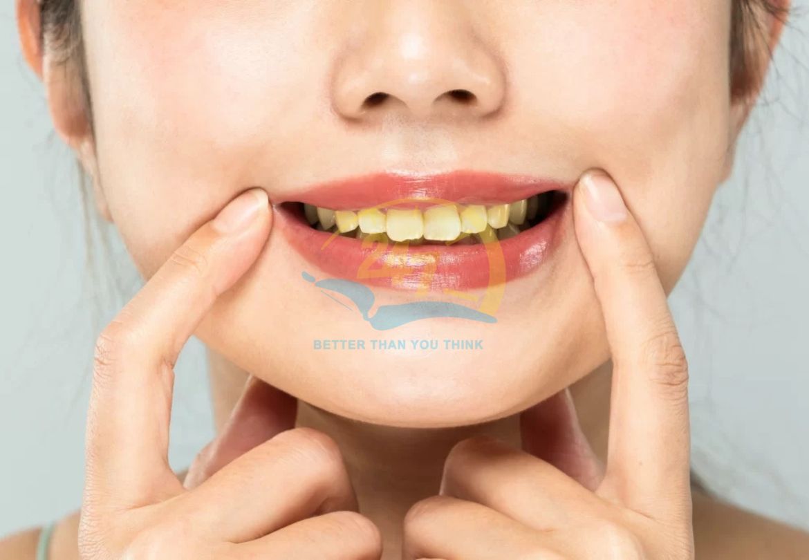 Chăm sóc răng miệng sai cách có thể dẫn tới nhiều vấn đề nghiêm trọng cho sức khỏe răng miệng sau ngày Tết