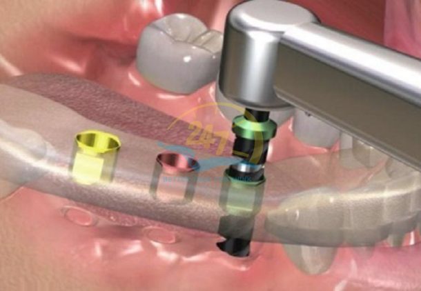 Bảo dưỡng máy cắm Implant định kỳ để tăng tuổi thọ thiết bị