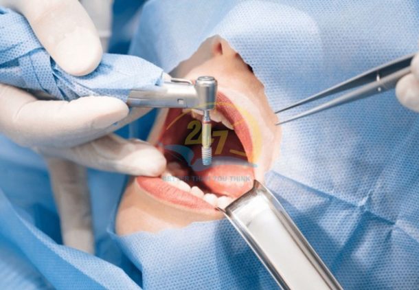 Bộ dụng cụ phẫu thuật răng hàm mặt