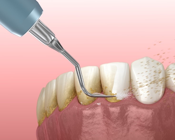 Dịch vụ lấy cao răng ngày càng phổ biến