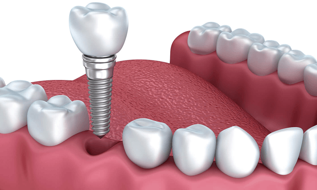 Chức năng chính của máy cắm Implant
